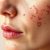 Dermatolog: Diagnoza i leczenie chorób skóry oraz konsultacje